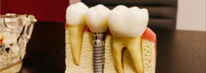dental implants