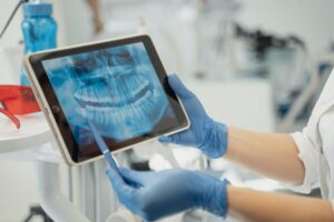 wisdom teeth removal in Oxnard