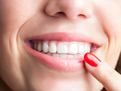 dental implants